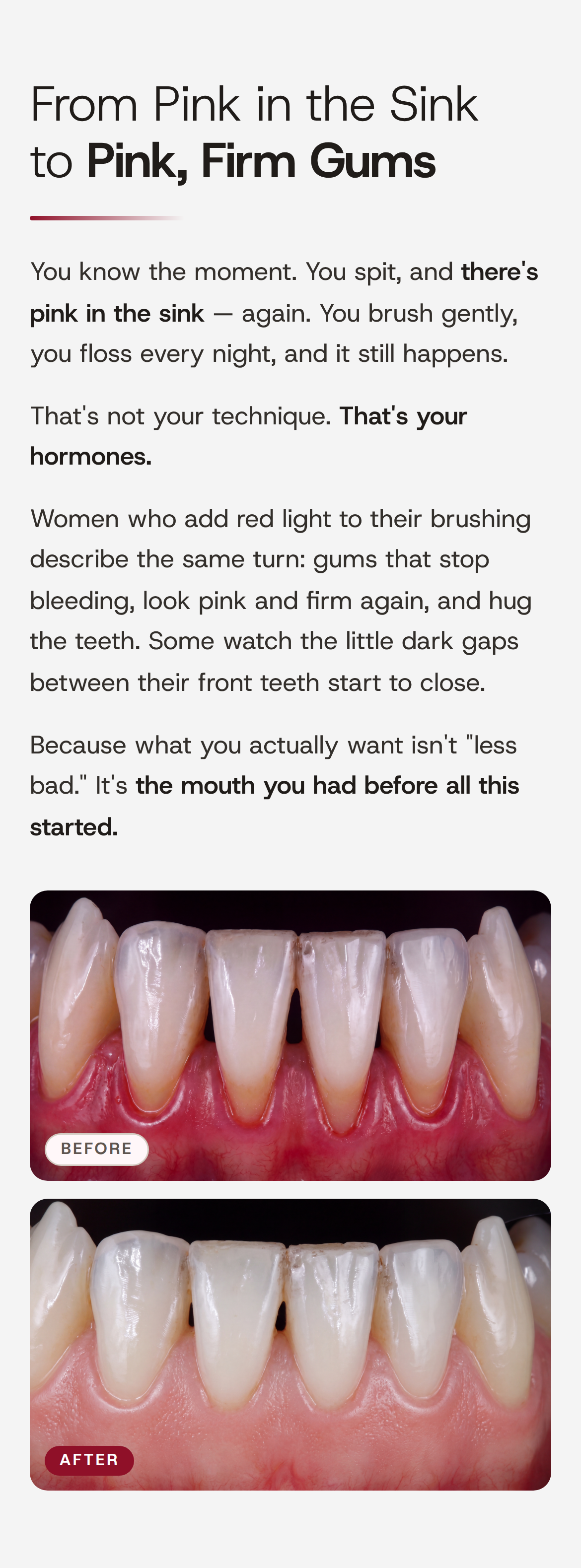 From Pink in the Sink to Pink, Firm Gums. You know the moment. You spit, and there's pink in the sink — again. You brush gently, you floss every night, and it still happens. That's not your technique. That's your hormones. Women who add red light to their brushing describe the same turn: gums that stop bleeding, look pink and firm again, and hug the teeth. Some watch the little dark gaps between their front teeth start to close. Because what you actually want isn't "less bad." It's the mouth you had before all this started. Two stacked close-up photos of the same lower front gums, labelled BEFORE and AFTER.