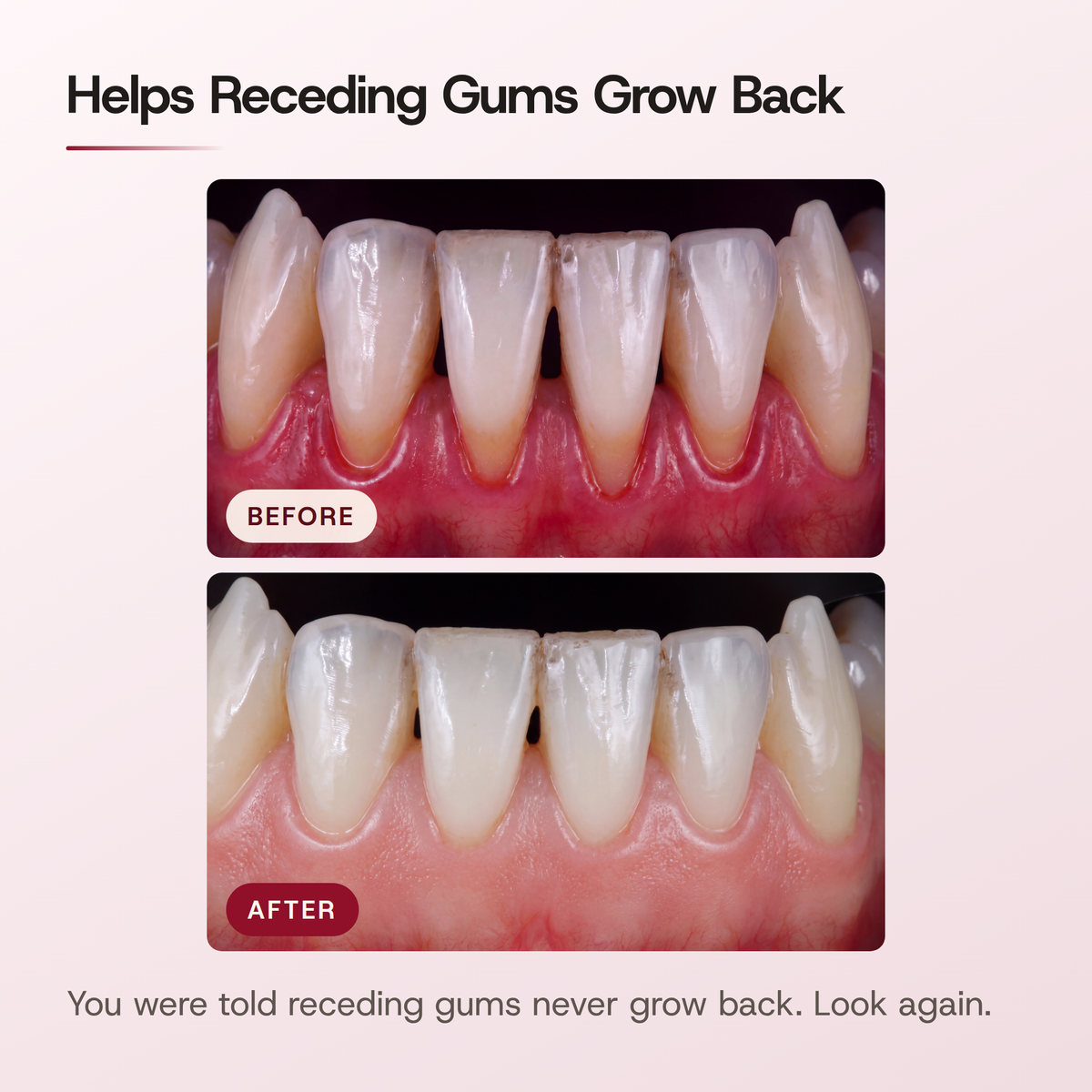 Helps Receding Gums Grow Back. BEFORE and AFTER close-up photos of the same lower front gums. You were told receding gums never grow back. Look again.