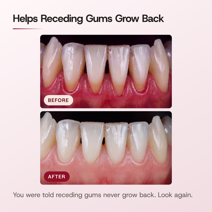 Helps Receding Gums Grow Back. BEFORE and AFTER close-up photos of the same lower front gums. You were told receding gums never grow back. Look again.